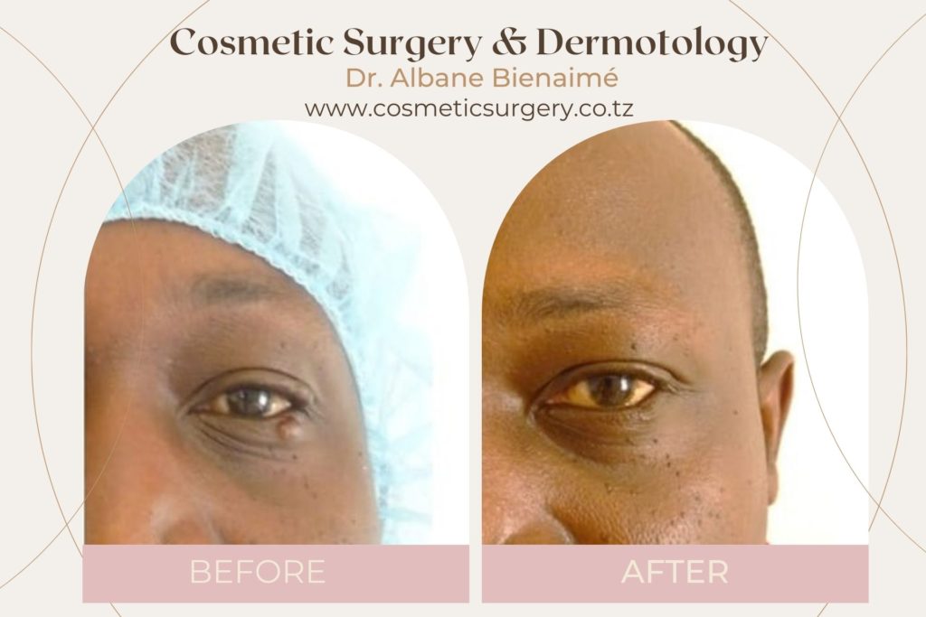 Eye Cyst Surgery Medical and Surgical Clinic